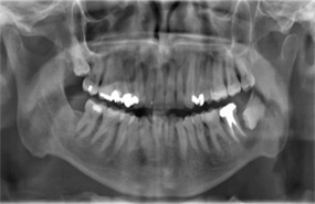Denti inclusi con cisti