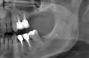 Mancanza del dente 26