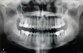 Ottavi inferiori inclusi e dente 46 compromesso