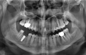 Sostituzione del dente 46 con impianto