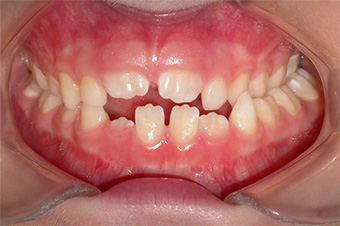 Ortodonzia intercettiva
